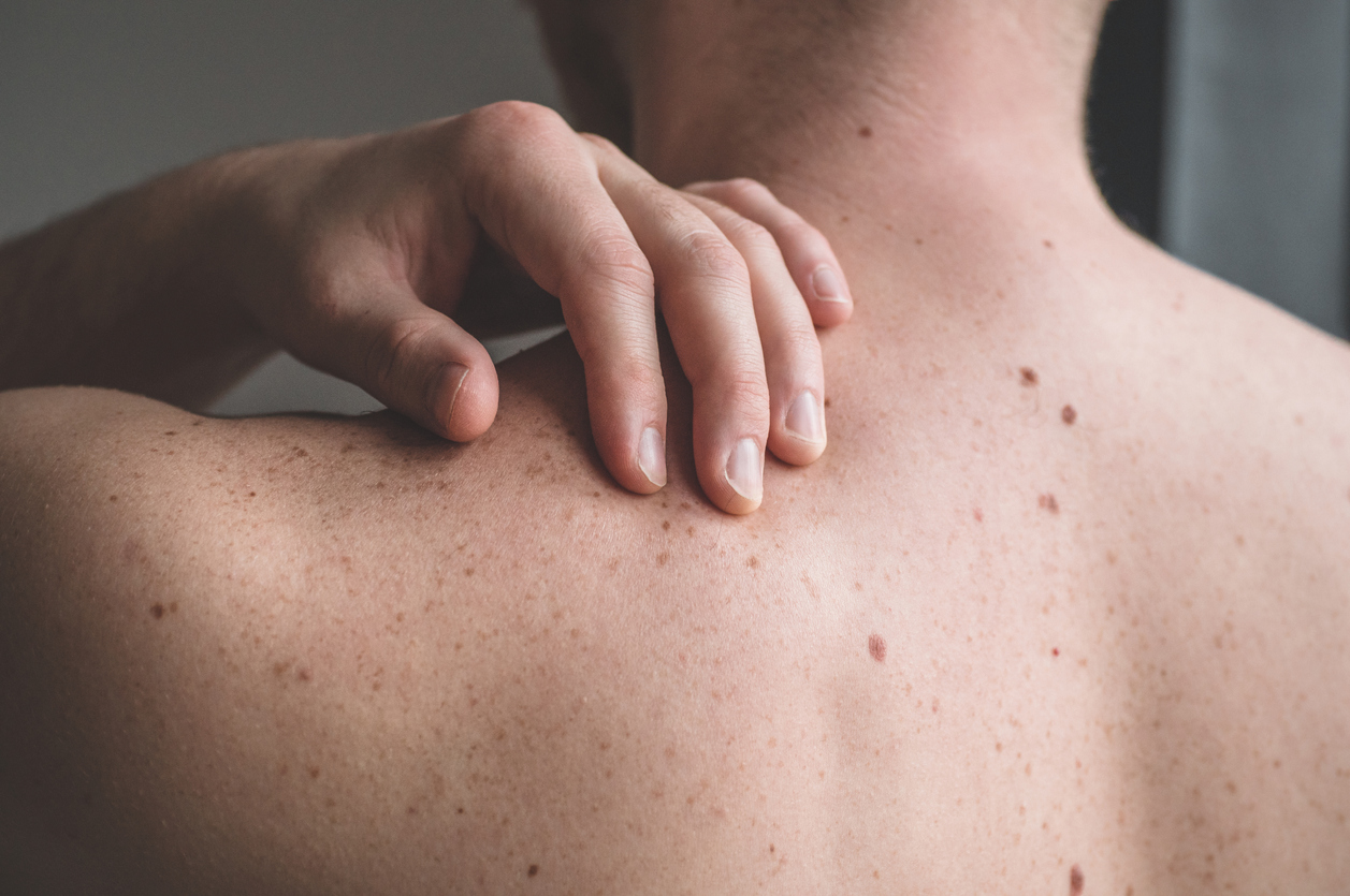 person with moles on his or her back in need of a skin biopsy