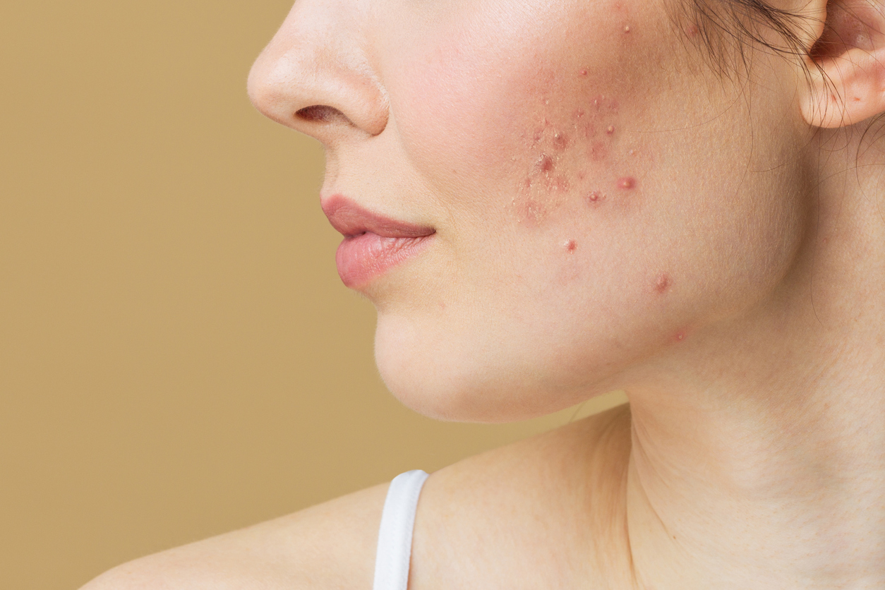 A closeup of a womens head turned and acne on her cheek