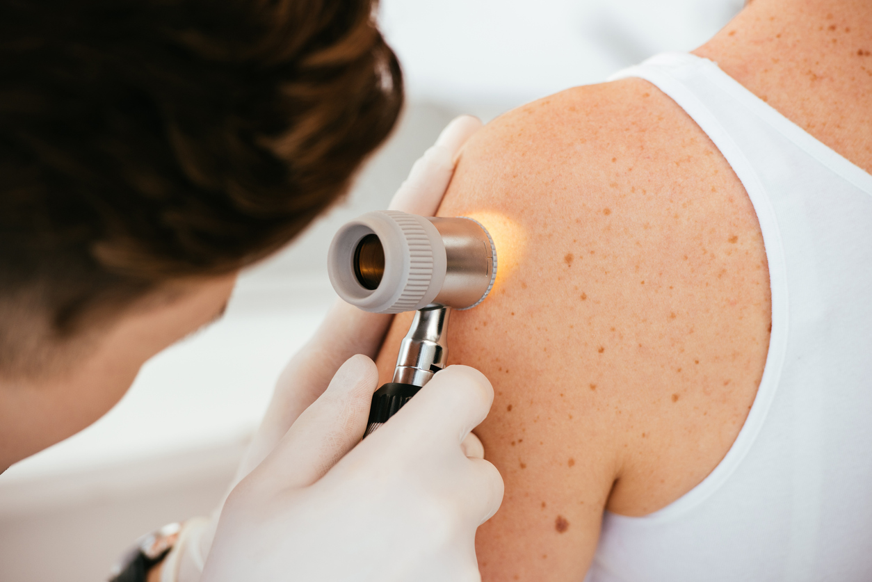 A dermatologist conducting a skin cancer screen using a dermascope