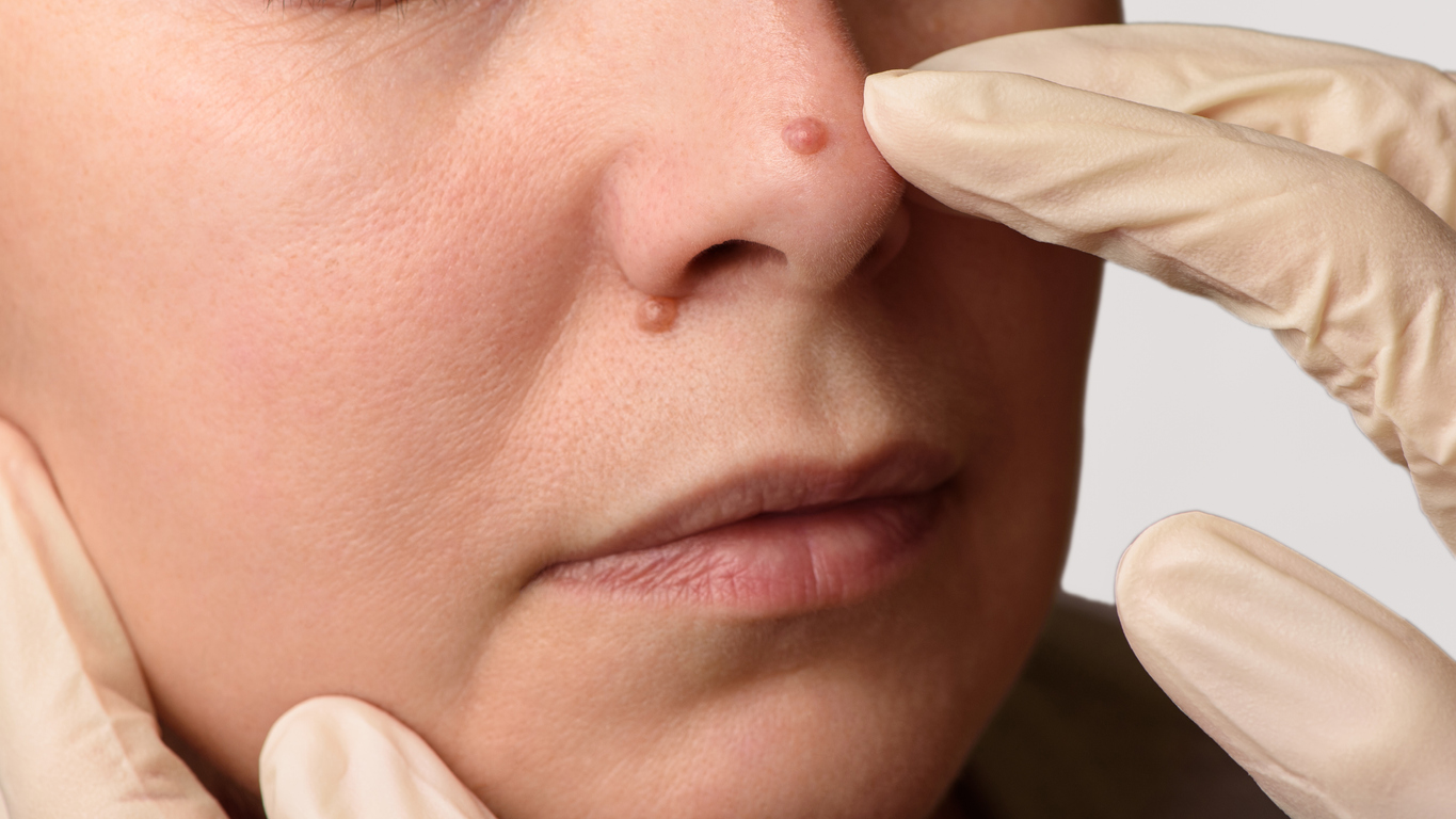 closeup of a patient with a mole on the nose experiencing dermatologist mole removal services